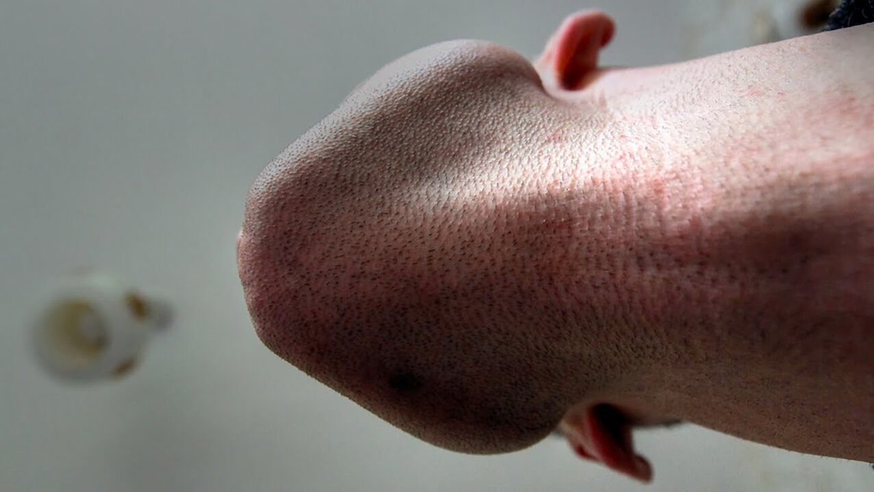 Penis başını büyütmeye yönelik bazı ürünler alerjiye neden olabilir