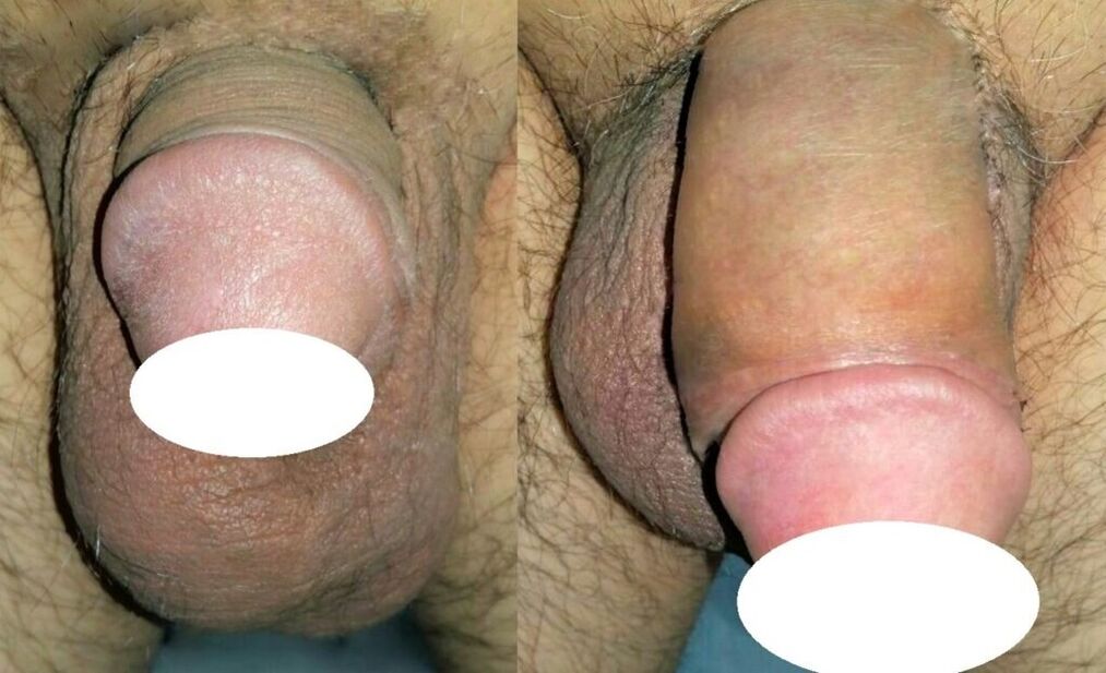 penis büyütme öncesi ve sonrası fotoğraflar